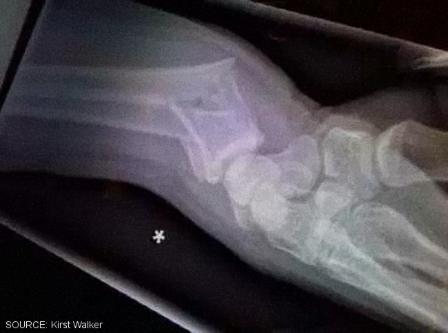 Broken wrist X-Ray.